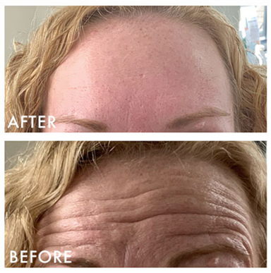 before and after photo of woman's forehead
